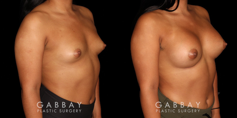 Patient 05 3/4th Right Side View Breast Augmentation Silicone Implants Gabbay Plastic Surgery