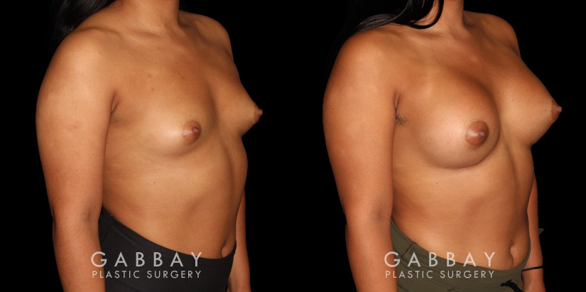 This is a young woman with a tuberous or constricted breast deformity. The lower portion of the breast developed more tightly than the rest of the breast. She wanted a more full, but natural breast appearance. She had silicone breast augmentation, with placement of an Allergan naturelle soft touch silicone breast implant through a lower breast/inframammary fold incision. Her moderate profile implants were 310 cc. Patients like this are prone to lower breast complications such as a double bubble, but with careful performance of the operation, she easily avoided this complication.