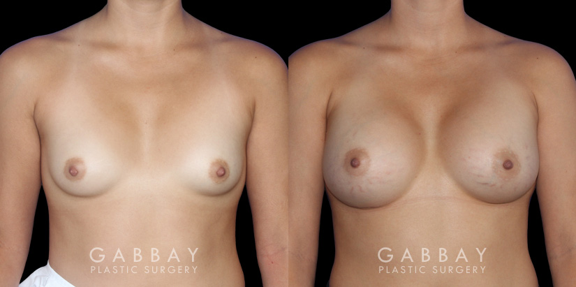 Photos showing patient following complete recovery from breast augmentation with silicone implants. Breast volume increased from minimal size to full, refined volume.