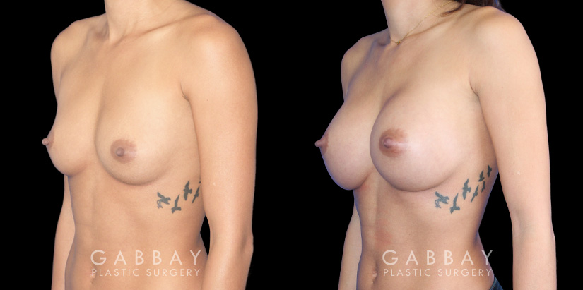 Breast augmentation patient with final results Note the significant increase in breast volume while keeping the shape within natural bounds. Note the absence of visible scarring which is rare with such increases in breast volume.