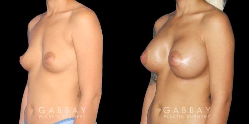 Before-and-after photos for breast augmentation with saline implants. The choice of saline implants allowed for more dramatic increase in breast size while having no visible scars.