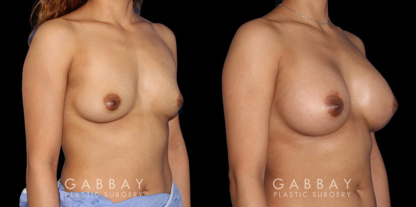 Silicone implant results for female patient in her 30s. Mild increase to volume allowed for balanced results that match her natural body contours.