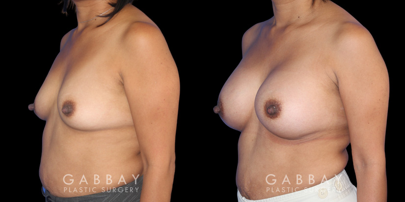 Patient before and after silicone implants with complete, uncomplicated recovery. Volume increase is notable while also improving the balance between breasts without resorting to unnatural perfect symmetry.