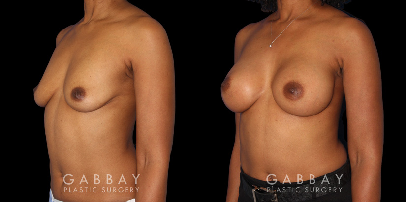 Before-and-after photos for saline implant breast augmentation patient. Her implant choice allowed for more natural shape and slope to the breasts, most notable in the profile view.