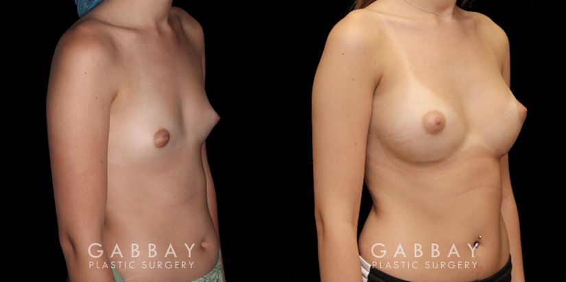 Before and after silicone breast implants for breast augmentation. Note the natural slope to the breasts and the symmetrical appearance while still increasing overall size.