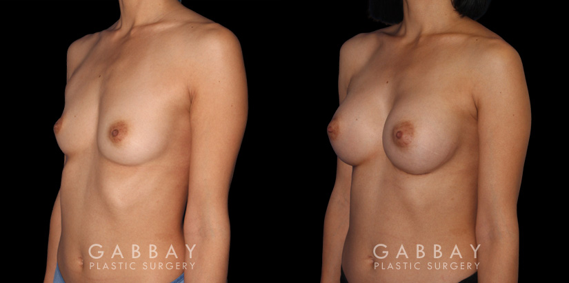 Patient result photos following silicone implant breast augmentation. Patient elected for a rounder shape with mild breast protrusion for subtle yet alluring results.