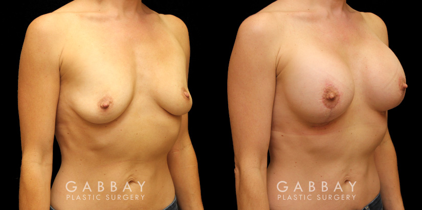 Patient with combined areola lift and breast augmentation, photos showing her before and after the procedure. Not the improved breast position and increased volume.