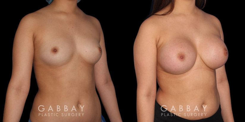 Silicone breast implants after full recovery. Patient increased breasts by several cup sizes without stretching out the skin, maintaining a round alluring shape with boosted volume.