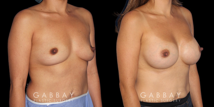 Silicone implants used to increase breast volume while keeping a natural shape. Patient healed well with no complications.