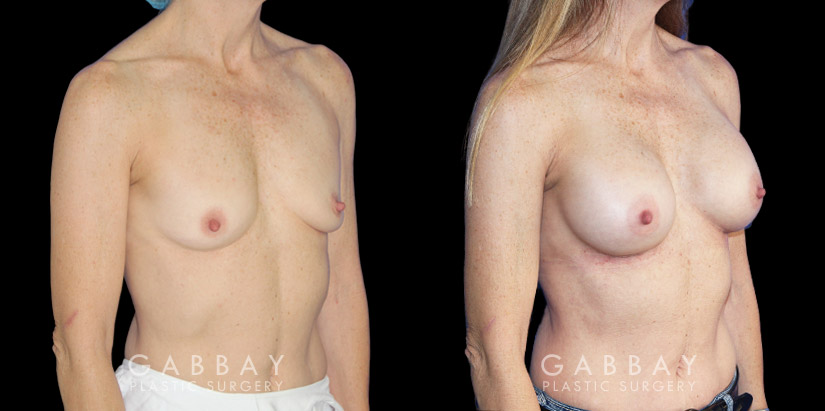 Female patient in her late 40s with breast augmentation results using silicone implants. Patient healed well and achieved a breast size and appearance that enhances a youthful contour and appearance.