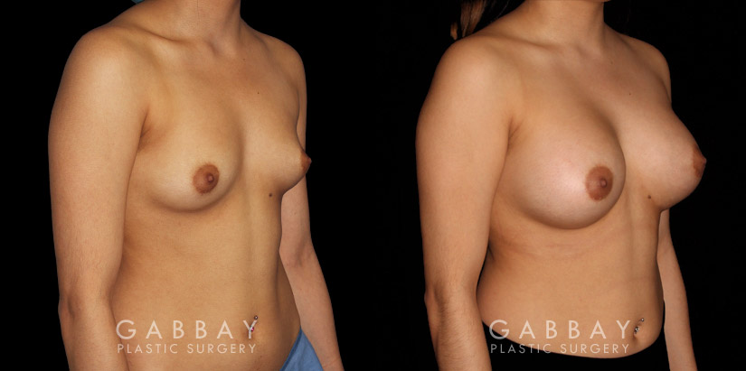 Breast augmentation patient results with silicone implants after fully healed. Breast size increased by multiple cups while keeping a natural balance between breast size and the patient’s body type.