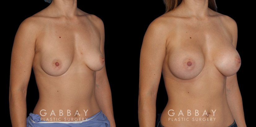 Silicone breast implants results. Note how the breast slope was retained in profile while still achieving a notable bust silhouette.