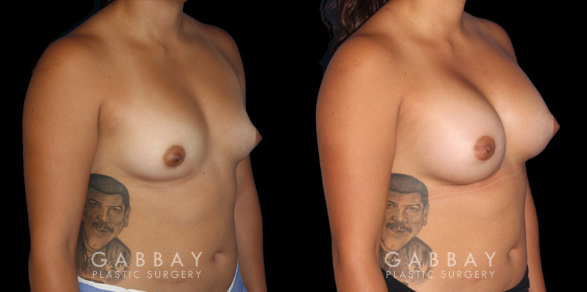 Breast Augmentation before-and-after photos demonstrating increased breast volume using silicone implants. Patient sought a milder increase to bust while keeping the volume within a natural range.