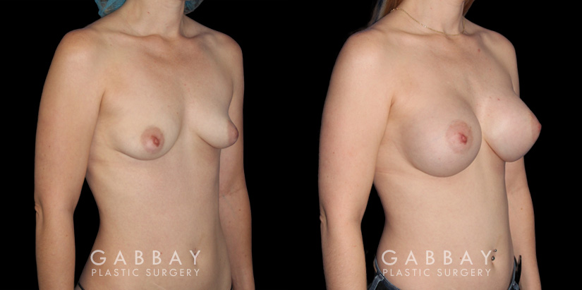 Silicone implants results for female patient in her 30s. Smaller, loose breasts were augmented to a firmer, taut volume with minimal overhang for improved comfort.