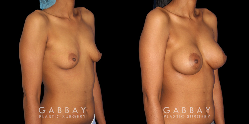 Silicone implants were used to increase breast volume while preserving the patient’s natural breast shape. The increased bust size resulted in a feminine, refined profile.