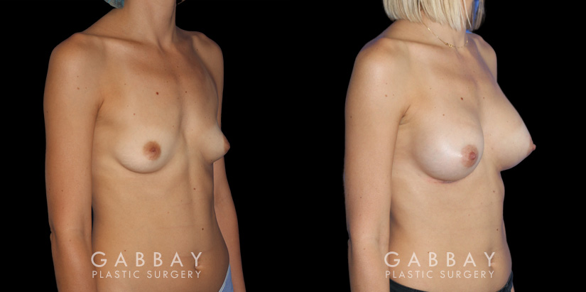Using silicone implants, the patient saw increased breast volume while maintaining a comfortable, proportionate size. Nipple position and overall breast aesthetic was maintained while increasing size.