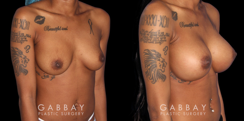 Patient with significant breast volume increase through breast augmentation with silicone implants. Profile view demonstrates the enhanced breast size by silhouette with an alluring, round shape.