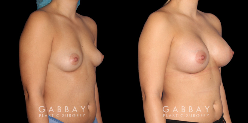 Silicone implants used to increase breast size in female patient in her 30s. Boost ot breast volume resulted in a more feminine contour from each before-and-after photo angle.