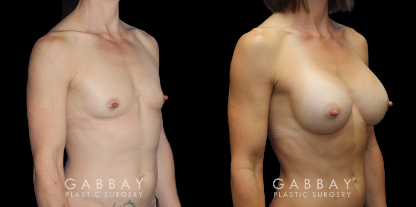 Breast augmentation results for patient with slim and fit body type. The silicone implants were chosen to match this tighter physique for a natural balance.