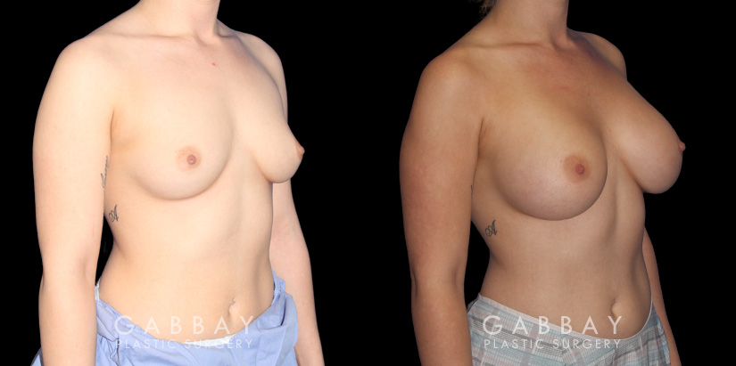 Smoother recovery for patient who chose silicone implants for breast augmentation. Breast position was maintained to keep a natural look that enhances her body type’s contours.