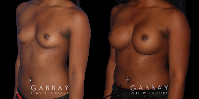 Patient results following recovery of breast augmentation using silicone implants. Note the increase in sense of fullness despite only boosting volume a restrained amount.