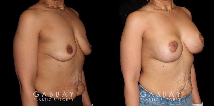 Patient with combined breast lift and breast augmentation using saline implants. Patient fully recovered from the combination procedure with excellent results.