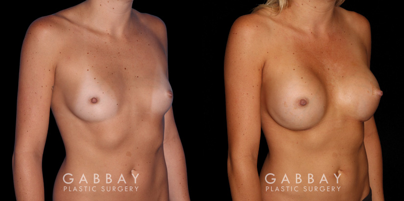 Breast augmentation before-and-after photos for patient with silicone implants. Increased volume resulted in pleasantly round breasts without excessive change.