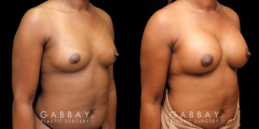 Patient before and after receiving silicone implants to increase breast roundness and overall volume. Results are shown following complete, smoother recovery.