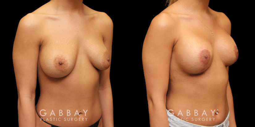 Before-and-after photos for patient who had removal and replacement of silicone implants (capsulorrhaphy). Final procedure included a breast lift to restore the position of the breasts.