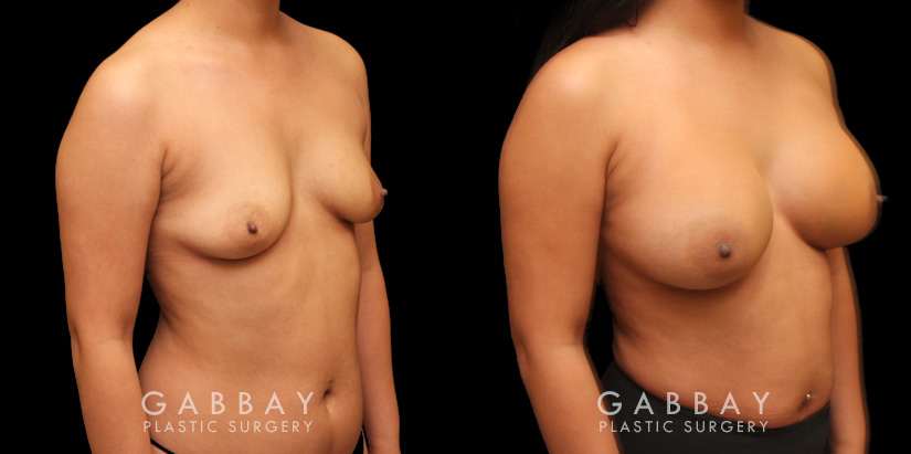 Photos for female patient before and after silicone implant procedure. Note the robust increase in breast size while continuing to match her body's aesthetic for an aligned appearance.