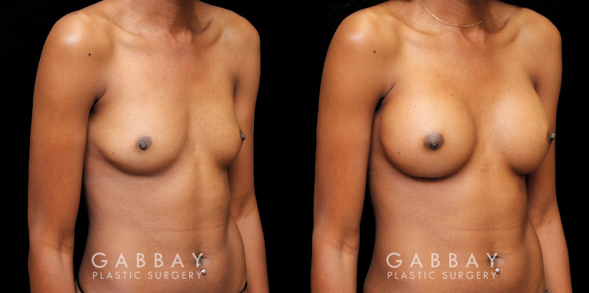 Patient before-and-after photos for breast augmentation with silicone implants. Patient increased cup size while maintaining a natural, balanced look to the breasts.