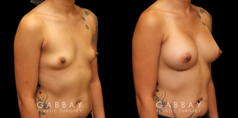 Silicone implants were used to increase breast roundness and volume. Note how the breasts kept their position while filling out for a balanced appearance.