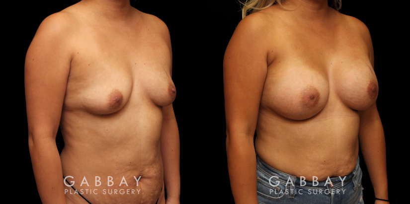 Before-and-after photos for female patient with breast augmentation. Classic results show improved size and volume of breasts with enhanced roundness from each angle.