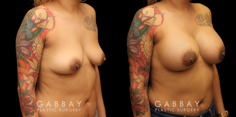 Silicone implant breast augmentation photos showing before and after the procedure (post complete recovery). Patient breasts are demonstrably rounder with a balanced volume increase that suits her body shape.