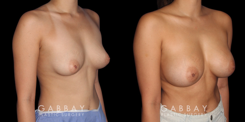 Female patient in her 20s before-and-after revision breast augmentation, including implant removal and replacement with additional breast lift to improve breast position.