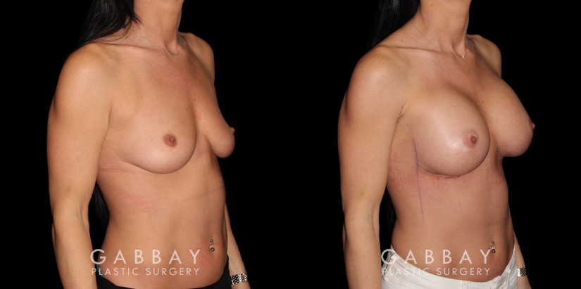 Patient breasts with silicone implants following complete recovery. Now how the incisions are hidden in the breast folds, making them invisible from most angles.