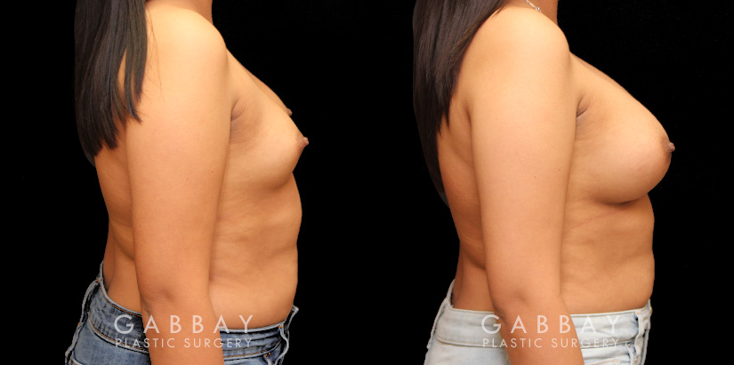 Patient 81 Right Side View Breast Augmentation Silicone Implants Gabbay Plastic Surgery