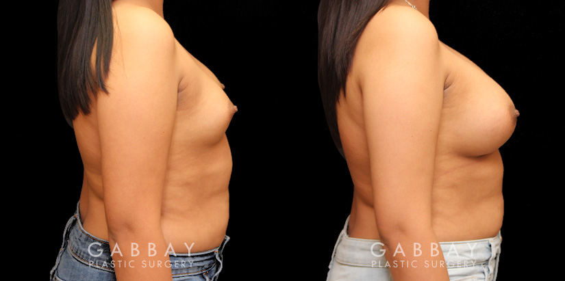 Using silicone implants, patient wanted a mild boost to breast volume without dramatic results. The final look has enhanced roundness while keeping to the patient’s natural breast shape and position before the procedure.