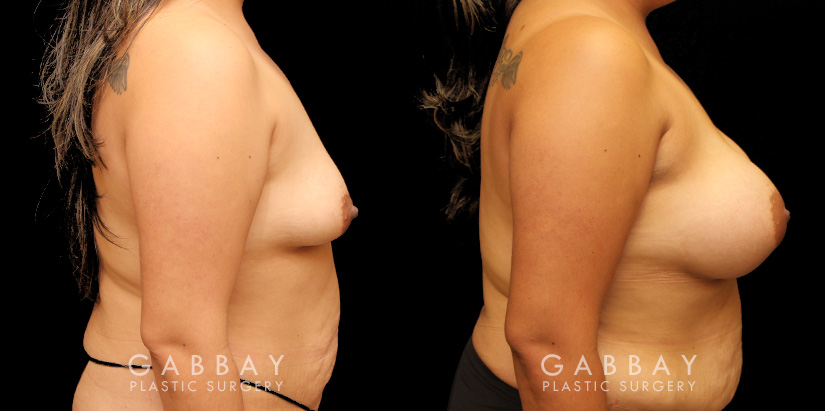 Patient 82 Right Side View Breast Augmentation Silicone Implants Gabbay Plastic Surgery
