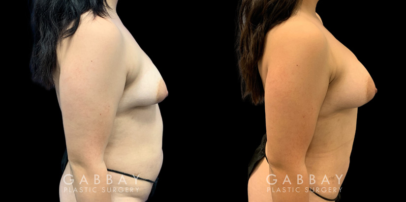 Patient 04 Right Side View Breast Fat Grafting Gabbay Plastic Surgery