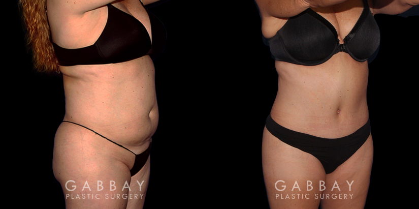 Abdomen and Waist Liposuction - Before and After Photos