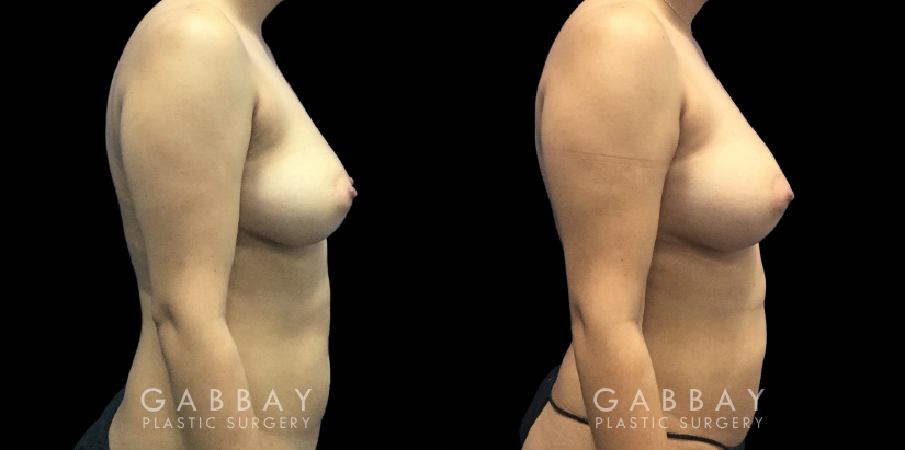 Patient 08 Right Side View Breast Fat Grafting Gabbay Plastic Surgery