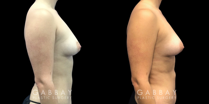 Patient 09 Right Side View Breast Fat Grafting Gabbay Plastic Surgery