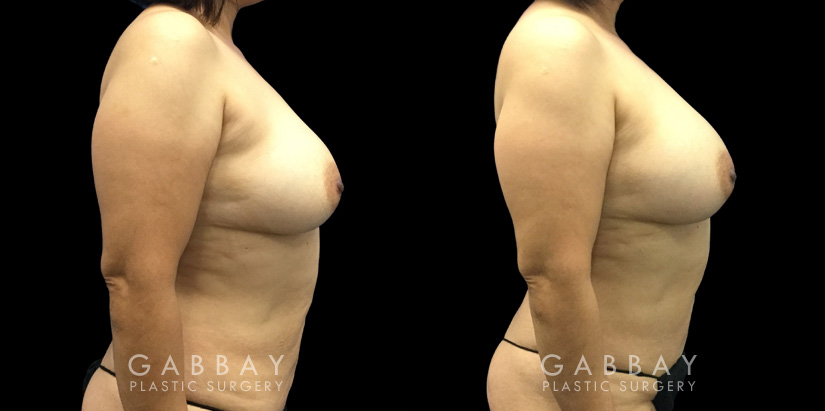 Patient 10 Right Side View Breast Fat Grafting Gabbay Plastic Surgery