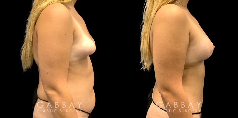 Patient 11 Right Side View Breast Fat Grafting Gabbay Plastic Surgery