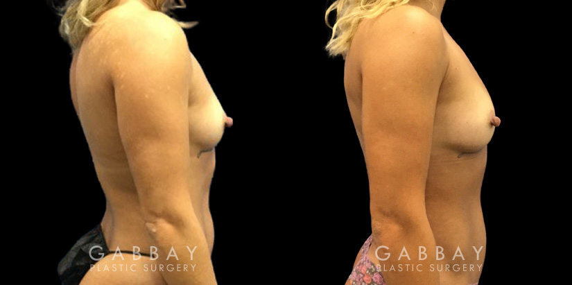 Patient 12 Right Side View Breast Fat Grafting Gabbay Plastic Surgery
