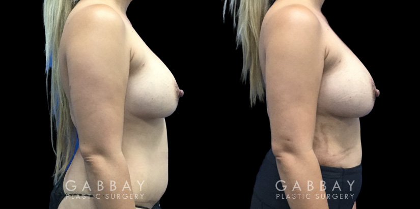 Patient 13 Right Side View Breast Fat Grafting Gabbay Plastic Surgery