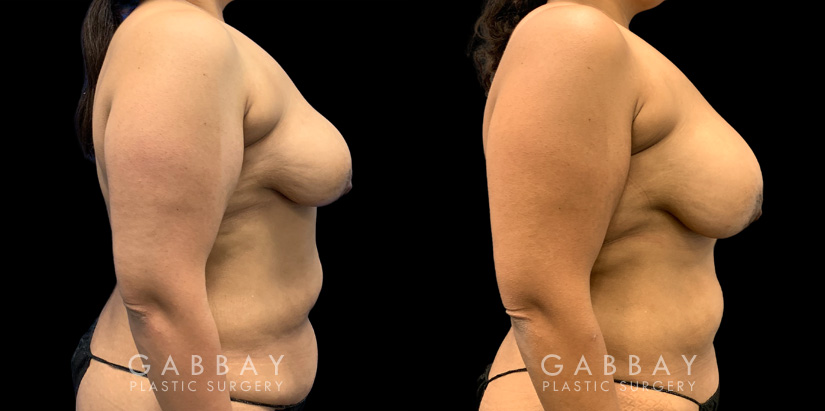 Patient 15 Right Side View Breast Fat Grafting Gabbay Plastic Surgery