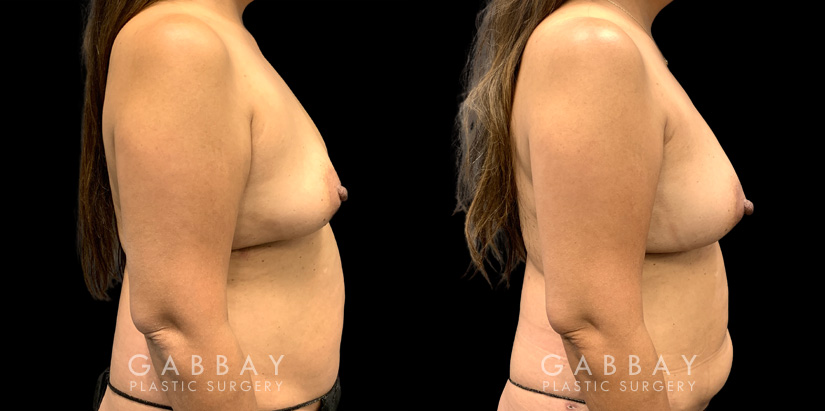 Patient 16 Right Side View Breast Fat Grafting Gabbay Plastic Surgery