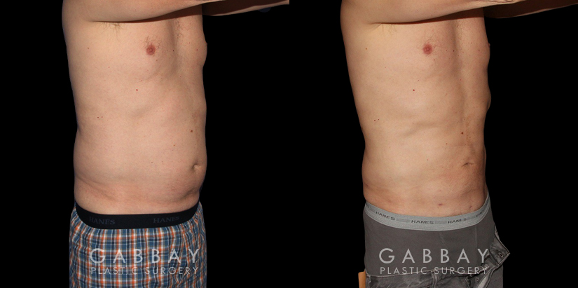 Male patients with liposuction results for full abdominal contouring. Patient healed well with minimal visible scarring and a flat stomach as seen in the profile view.